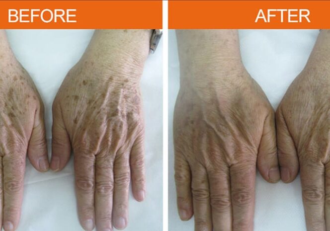 Before-After Age Spots - Hands