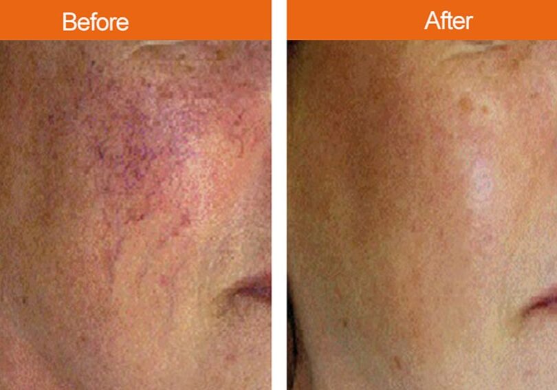 Before-After Hyperpigmentation