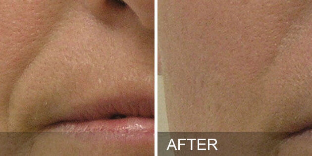 before-after-NasolabialFolds